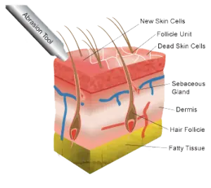 Microdermabrasion Skin Treatment Services in Phoenix Arizona