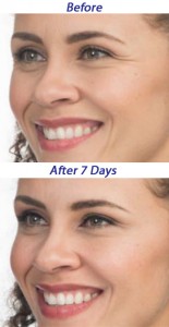 Botox® Cosmetic for mild to moderate crow's feet and glabellar lines
