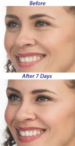 Botox® Cosmetic for mild to moderate crow's feet and glabellar lines