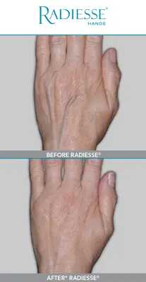Radiesse® For Hands - Aesthetic Medicine Phoenix