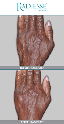 Before and After Radiesse® for Hands Injections