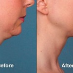 Kybella double chin treatment