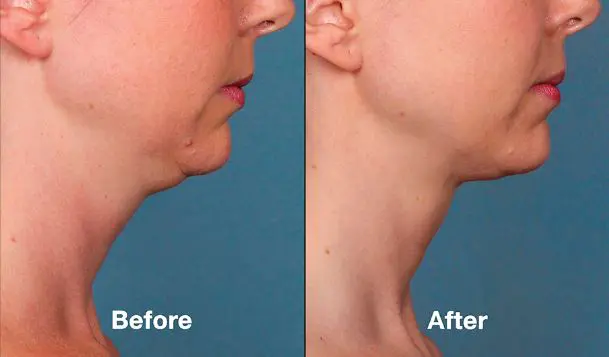 Kybella double chin treatment