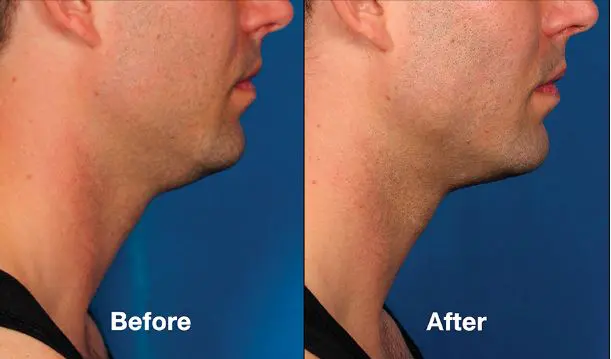 Reducing your double chin with kybella