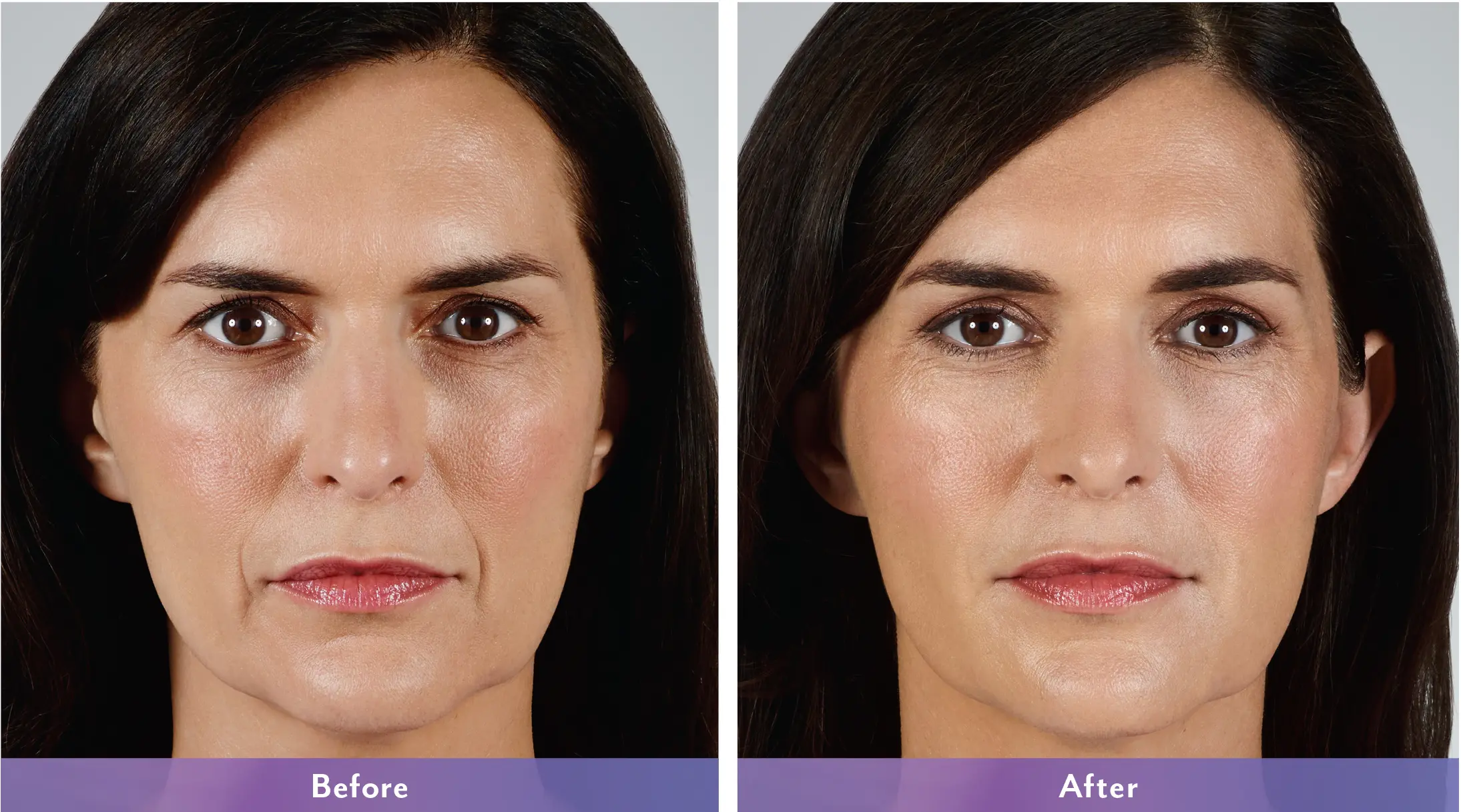Before and after using JUVÉDERM VOLLURE™ XC