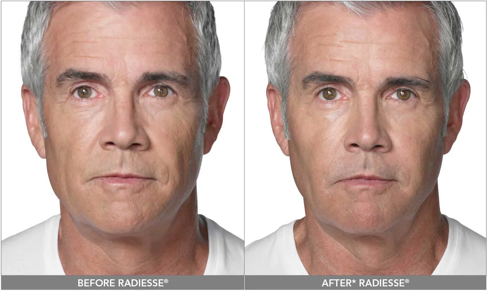before and after male patient using radiesse +