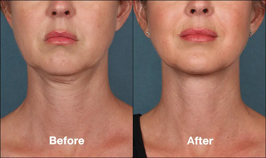 before and after using Kybella to get rid of double chin