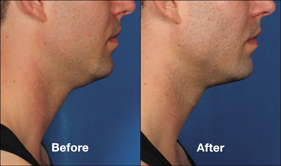 before and after side view to eliminate double chin with Kybella