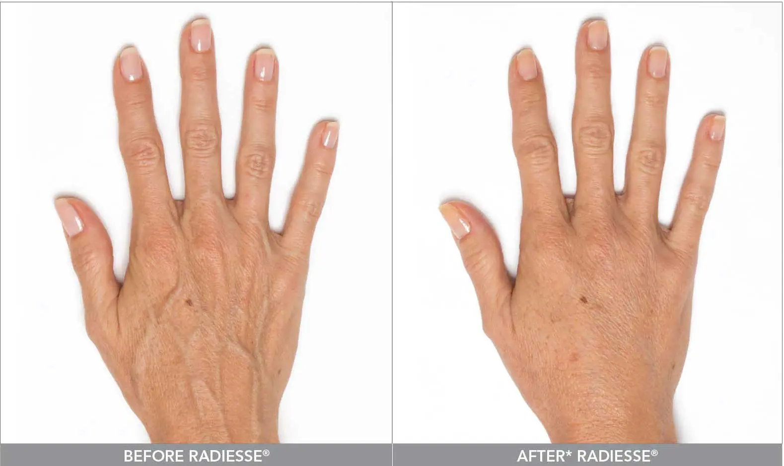 before and after using radiesse + on hands