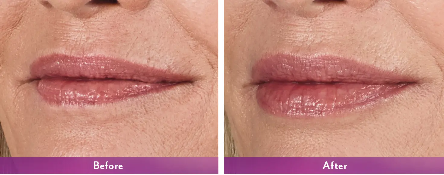 Before and after using JUVÉDERM VOLBELLA® XC for vertical lines on lips