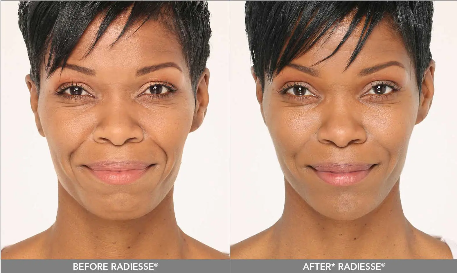 before and after female patient using radiesse +