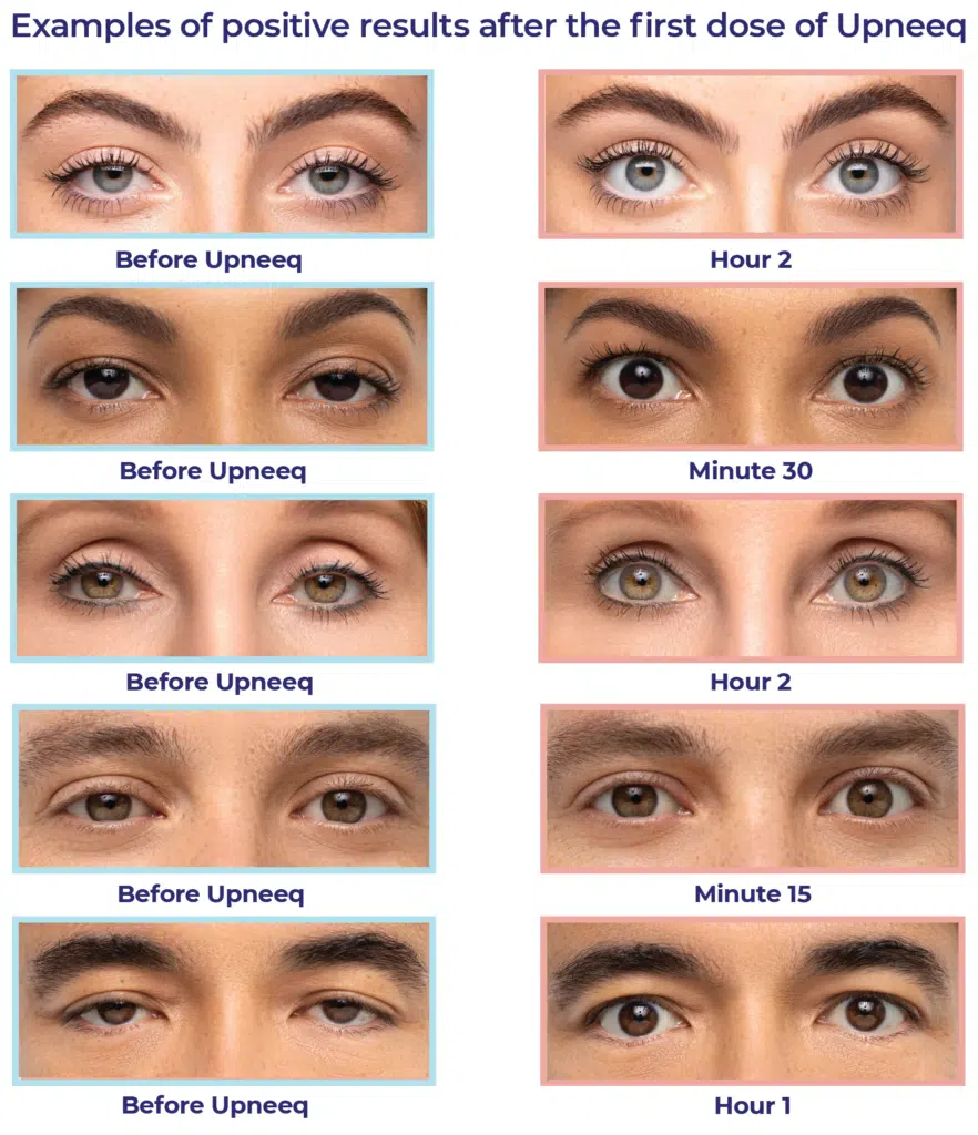 UPNEEQ® (low-lying lids) in adults Before and After